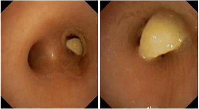 Role of Unilateral Vocal Cord Palsy in Causing Recurrent Tracheobronchial Foreign Bodies